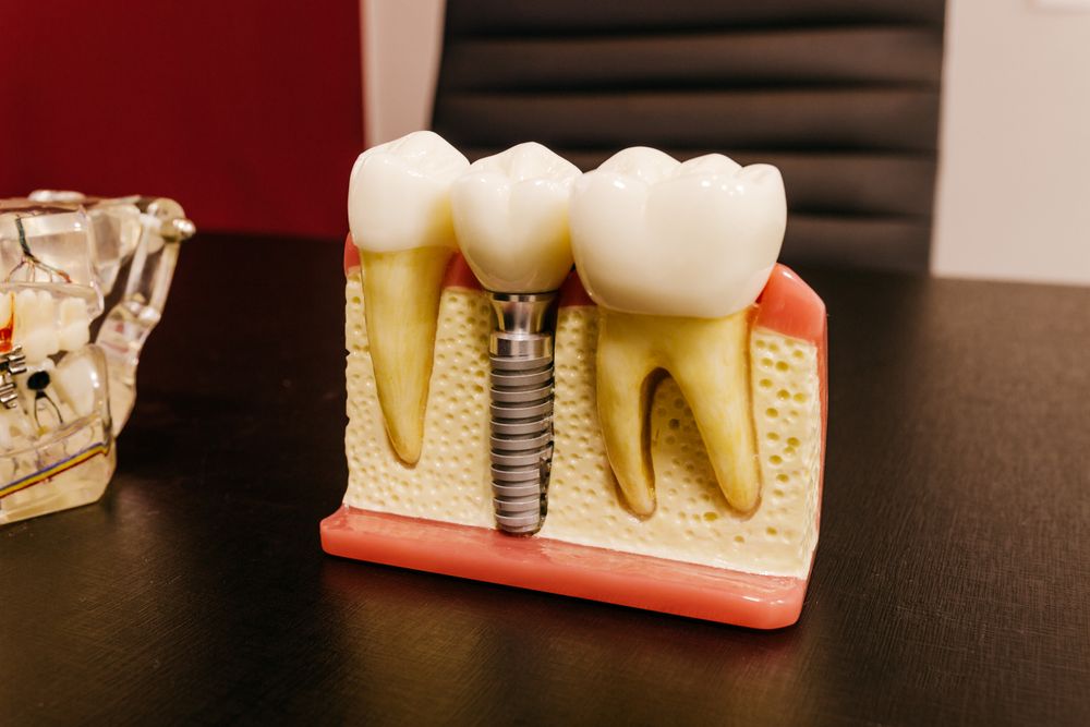 Model implantu dentystycznego na biurku gabinetu